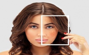 4 cách tự nhiên giúp làm giảm nám da hiệu quả