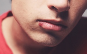 Video: Nên làm gì để đối phó với rộp môi?