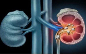 5 cách tự nhiên giúp làm tan sỏi thận