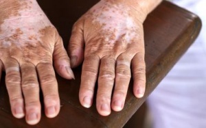 3 cách tự nhiên chữa lang ben ngay tại nhà