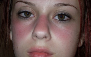 15 triệu chứng của lupus ban đỏ ít người để ý