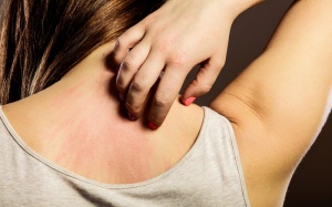 Những điều cần biết về vẩy nến thể giọt