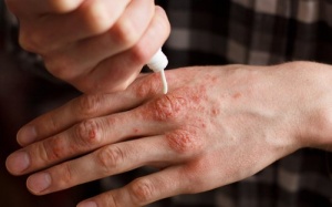 7 lời khuyên của bác sỹ giúp giảm triệu chứng của bệnh chàm hiệu quả