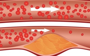 7 dấu hiệu nguy hiểm cảnh báo tắc động mạch