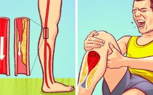 7 dấu hiệu tắc động mạch nguy hiểm thường bị bỏ qua
