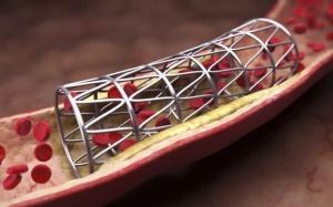 Đặt nhiều stent có ảnh hưởng gì tới người bị thiếu máu cơ tim?