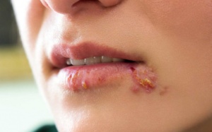Nhiễm herpes có làm tăng nguy cơ mắc Alzheimer? 