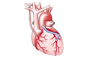 Phương pháp bắc cầu động mạch vành là gì, thực hiện thế nào?