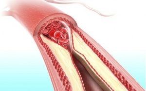 Những thực phẩm giúp giảm nguy cơ tắc nghẽn động mạch