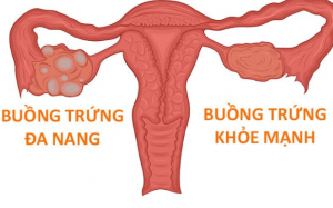 Hội chứng buồng trứng đa nang là gì? Làm thế nào để có con? 