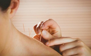 Châm cứu là gì? Châm cứu có thực sự hiệu quả?