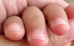 Bong tróc đầu ngón tay là bị bệnh gì?