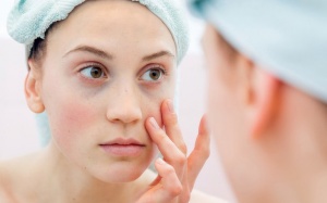 Xuất hiện các đốm ban mờ trên mặt có phải lupus ban đỏ?