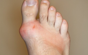 Làm sao để phòng bệnh gout tái phát trong dịp nghỉ Tết?