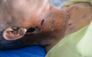 Tự ý chữa đái tháo đường, bệnh nhân loét nhiều phần trên cơ thể!