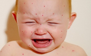 Những căn bệnh khiến trẻ bị phát ban