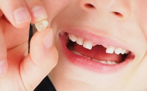 Sốc: Độ mỏng của men răng sữa giúp phát hiện sớm bệnh trầm cảm