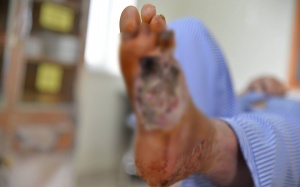 Gia tăng bệnh nhân đái tháo đường nhập viện vì biến chứng bàn chân