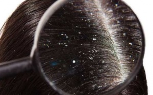 4 thành phần có thể giúp ngừa gàu một cách tự nhiên