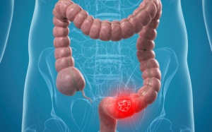 8 thói quen bạn nên thực hiện để giảm nguy cơ ung thư ruột kết