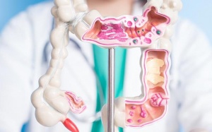 4 yếu tố làm tăng nguy cơ ung thư đại trực tràng