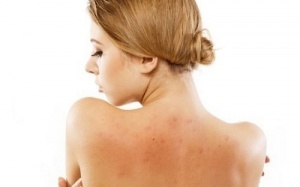 Các biện pháp tự nhiên giảm mụn trứng cá ở lưng
