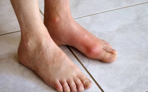 Những căn bệnh dễ nhầm với bệnh gout