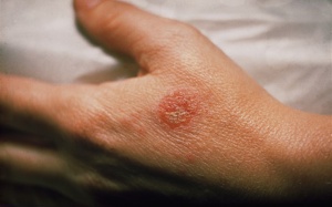 Những biện pháp tự nhiên giảm eczema