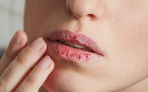 7 biện pháp tự nhiên trị môi khô, nứt nẻ đơn giản và hiệu quả