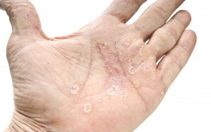 10 dấu hiệu cảnh báo bệnh vẩy nến thường gặp