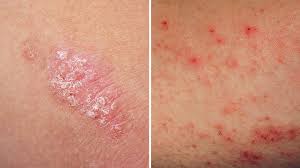 9 dấu hiệu cho thấy bệnh eczema của bạn đang trở nên nghiêm trọng