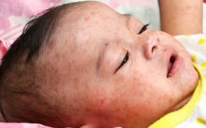 Làm sao để phòng biến chứng viêm não sau khi mắc bệnh sởi?