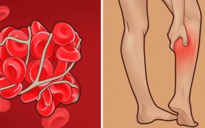 7 dấu hiệu thầm lặng cảnh báo cục máu đông