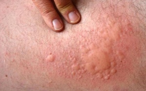 Những nguyên nhân khiến bạn bị nổi mề đay mạn tính