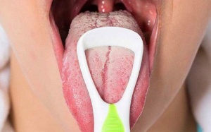 Lưỡi có nhiều vết nứt do đâu?