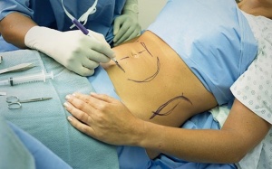 BV Bạch Mai thông tin về việc cô gái trẻ tử vong do hút mỡ bụng