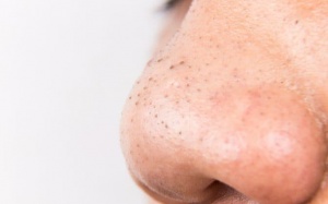 6 phương pháp giúp loại bỏ mụn đầu đen tại nhà