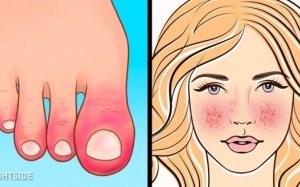 Điểm mặt 9 dấu hiệu dễ nhận thấy của rối loạn hệ miễn dịch