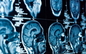 Béo phì làm giảm chất xám trong não