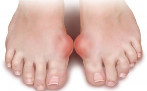 Điều gì xảy ra khi bị gout?