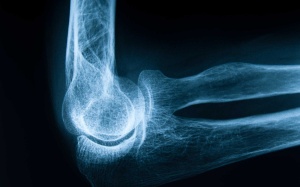 Những thói quen tưởng vô hại nhưng sẽ gây loãng xương