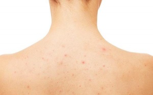 Trị mụn lưng thế nào để thoải mái diện bikini đi biển? 