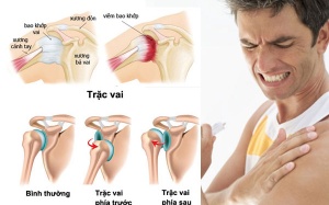 Cơ hội khám, tư vấn miễn phí người có chỉ định phẫu thuật khớp vai, khuỷu