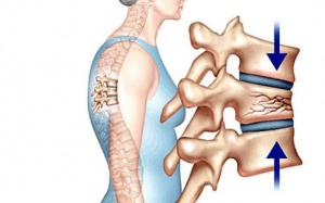 Lời khuyên về chế độ dinh dưỡng cho người bị loãng xương