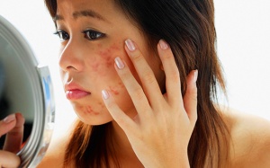 Phát hiện phương pháp mới có thể kiềm dầu, trị mụn trứng cá