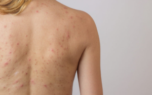 12 cách trị mụn toàn thân để thoải mái diện áo tắm, tự tin khoe dáng 