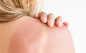 8 biện pháp tự nhiên giúp khắc phục làn da cháy nắng