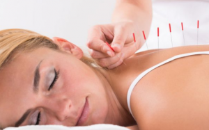 Châm cứu điều trị vô sinh: Hiệu quả thế nào?