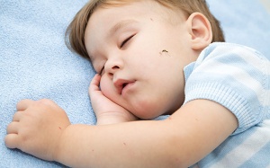 Trẻ bị sưng to ở vết muỗi đốt do đâu? 