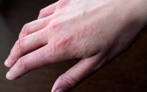 Làm sao để giảm eczema trên tay? 